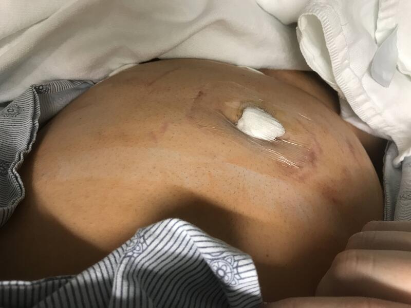 This is a picture taken of a person who has a bandaged wound on their midsection. Their midsection appears to be extremely swollen and probably painful. 